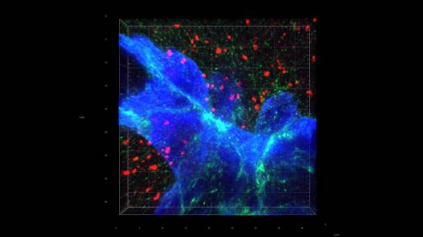 EPFL, Synapsen bei Brusttumor, KI, Medizin